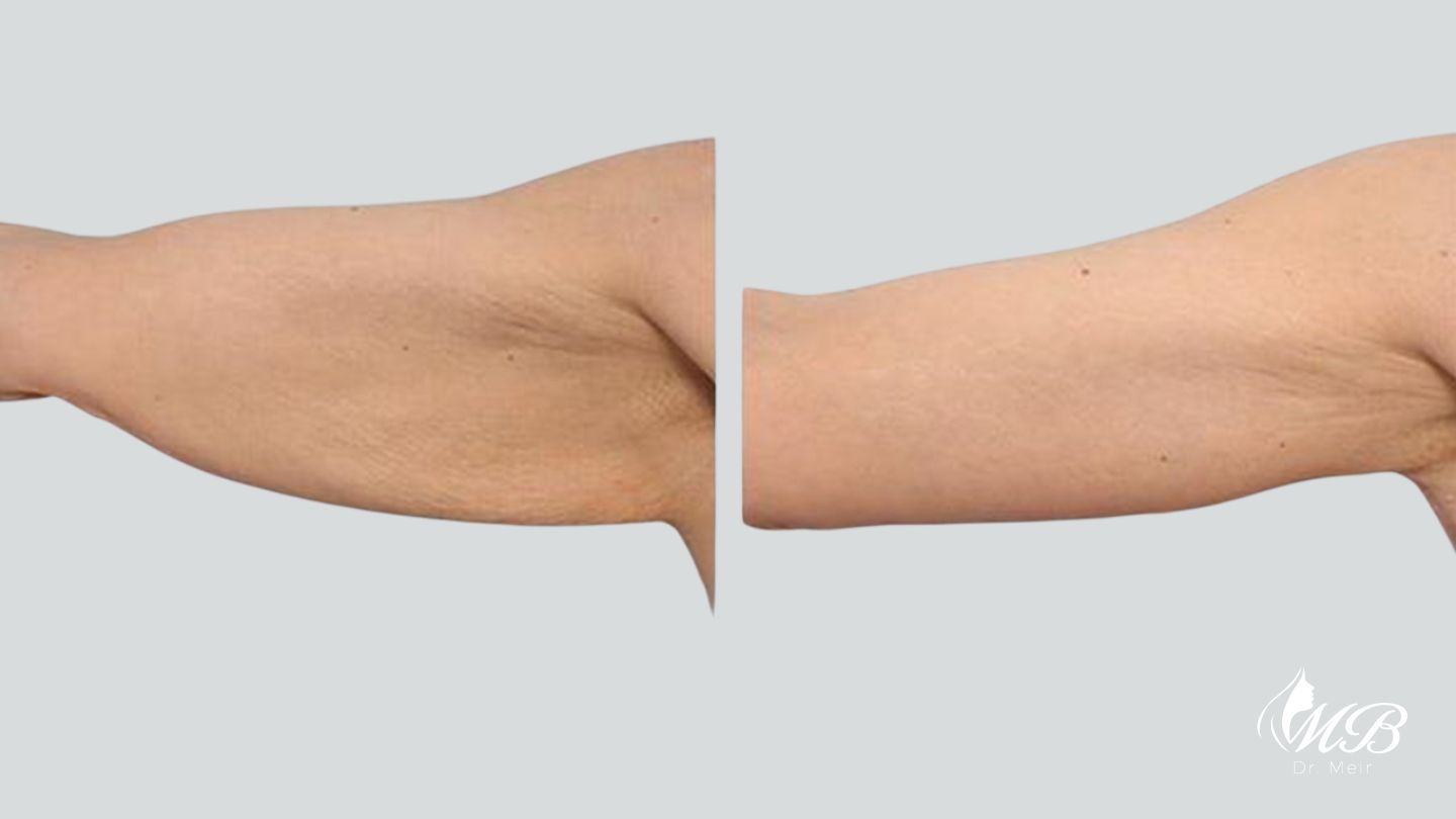 שאיבת שומן בזרועות לפני ואחרי